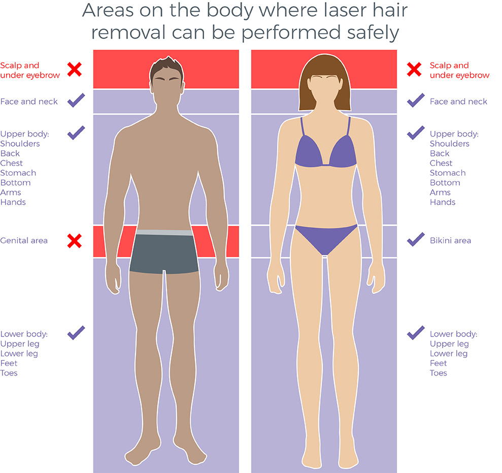 Laser Hair Removal - Avance Clinic